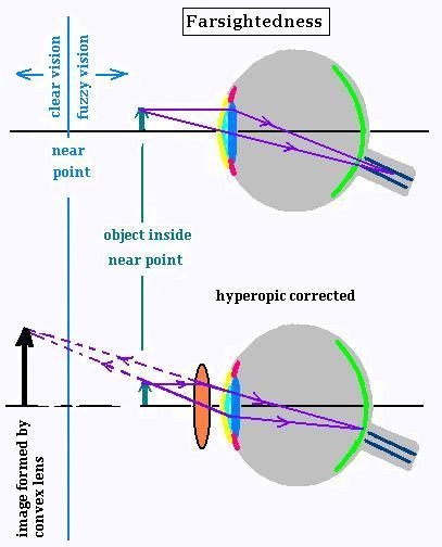 far point of eye